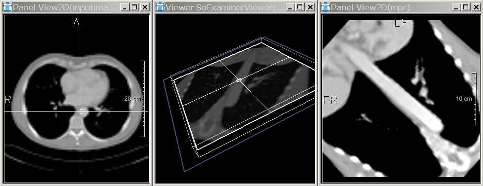 ../../../Modules/ML/MLResample1/mhelp/Images/MPRExample.jpg